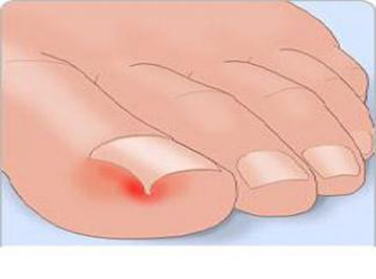 Ayak Baş Parmak Tırnak Ağrısı Belirtileri ve Tedavisi