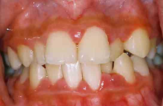 Diş Eti Ağrısına Ne İyi Gelir?