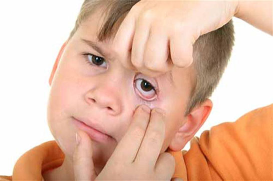 Göz Ağrısı Belirtileri ve Tedavisi