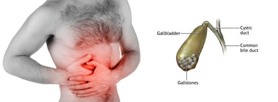 Safra Kesesi Taşı Ağrısı Belirtileri ve Tedavisi