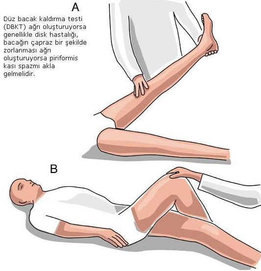 Siyatik Ağrısı Belirtileri ve Tedavisi