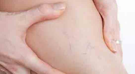 Varis Ağrısı Belirtileri ve Tedavisi